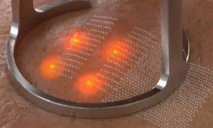 The exposure of laser on the skin