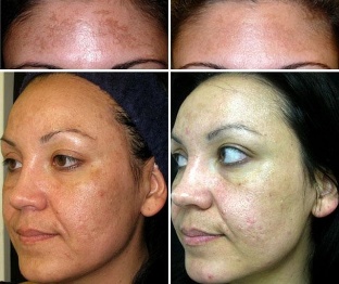 Before and after non-ablation fractional laser repair