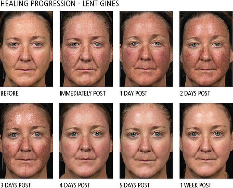 Progress in fractional laser treatment of facial skin