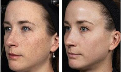Fractional facial rejuvenation before and after photos