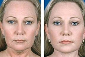 Laser facial rejuvenation before and after